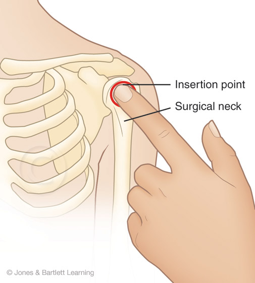 Illustration of Insertion Point for IO Needle
